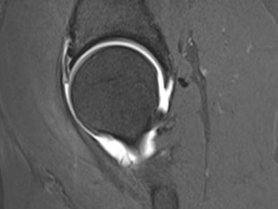 MRT Arthrographie Hüftgelenk mit Kontrastmittelinjektion und Extension
