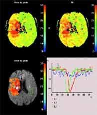 Diffusion-Perfusion